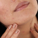 Acne Cleanser or Serum Product Testing